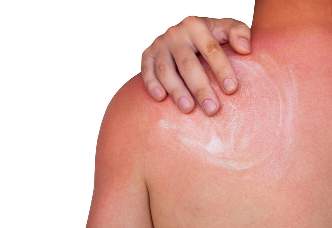 Image result for coconut oil for sunburn